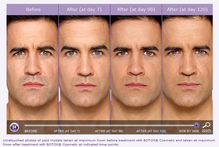 gohteia-empisteyontai-botox-andriko-brotox-to-poy-to-gia-thn-toys-mensdaygr